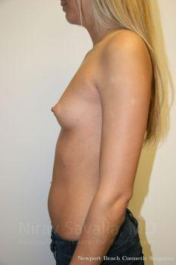 Arm Lift Before & After Gallery - Patient 1655581 - Before