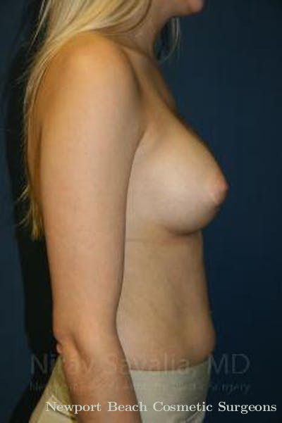 Breast Implant Revision Before & After Gallery - Patient 1655581 - After