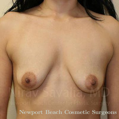 Chin Implants Before & After Gallery - Patient 1655582 - Before