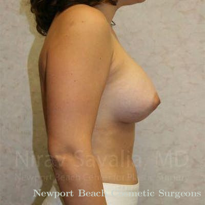 Chin Implants Before & After Gallery - Patient 1655583 - After