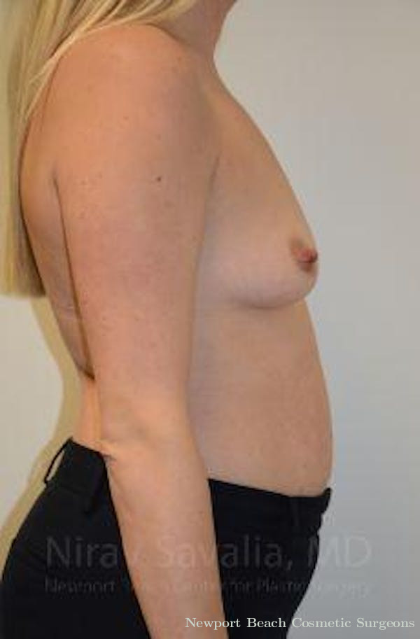 Male Breast Reduction Before & After Gallery - Patient 1655585 - Before
