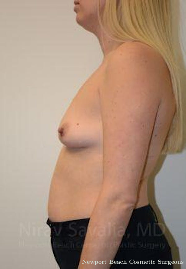 Breast Augmentation Before & After Gallery - Patient 1655585 - Before