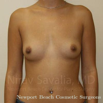 Male Breast Reduction Before & After Gallery - Patient 1655586 - Before
