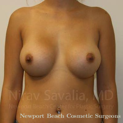 Mastectomy Reconstruction Before & After Gallery - Patient 1655586 - After