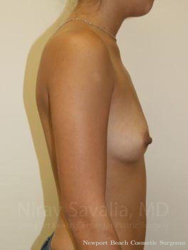 Abdominoplasty Tummy Tuck Before & After Gallery - Patient 1655586 - Before