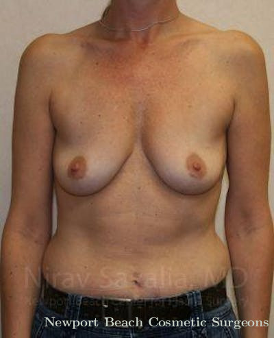 Mastectomy Reconstruction Revision Before & After Gallery - Patient 1655587 - Before