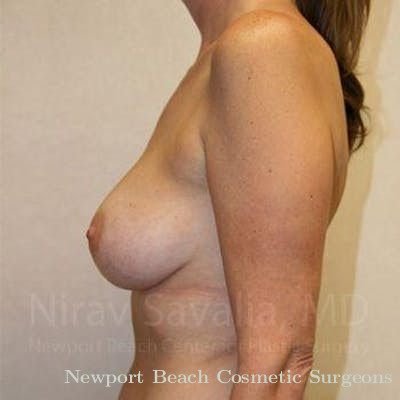 Breast Reduction Before & After Gallery - Patient 1655587 - After