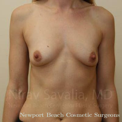 Breast Lift with Implants Before & After Gallery - Patient 1655589 - Before