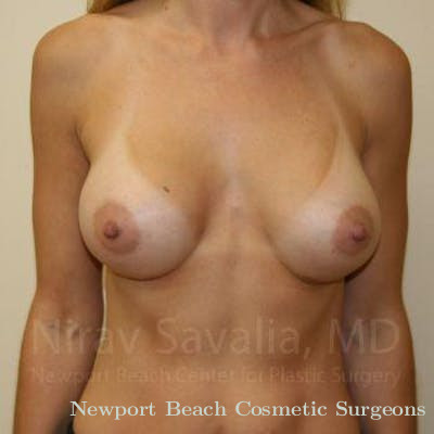 Breast Explantation En Bloc Capsulectomy Before & After Gallery - Patient 1655589 - After