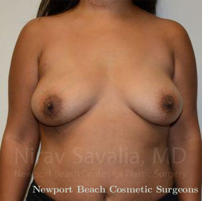 Breast Implant Revision Before & After Gallery - Patient 1655592 - Before