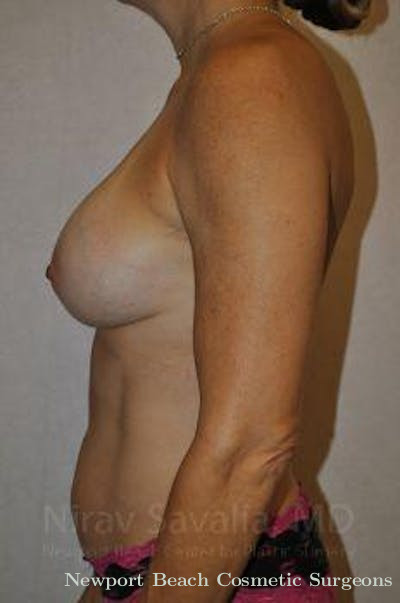 Mastectomy Reconstruction Before & After Gallery - Patient 1655594 - After