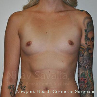 Breast Implant Revision Before & After Gallery - Patient 1655595 - Before