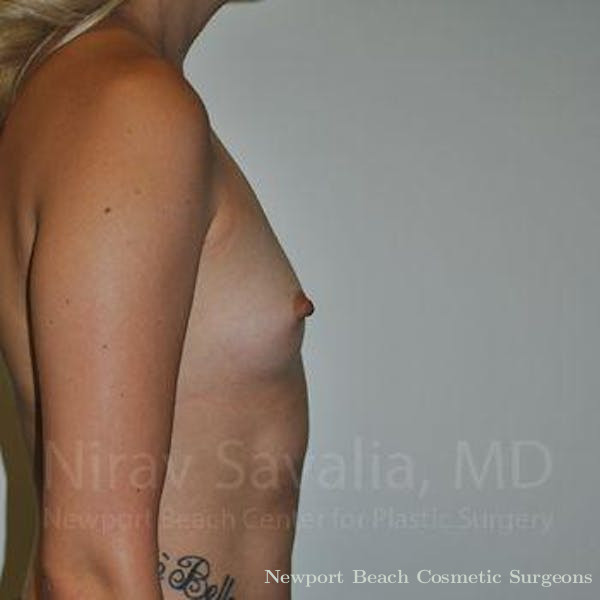 Breast Reduction Before & After Gallery - Patient 1655595 - Before