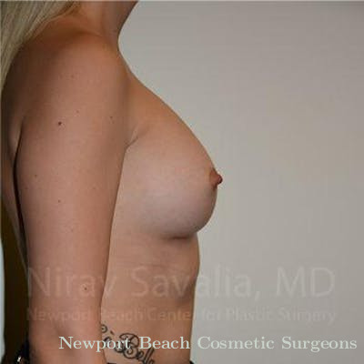 Facelift Before & After Gallery - Patient 1655595 - After