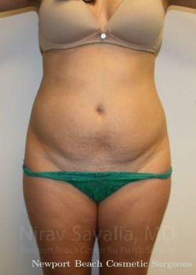 Breast Implant Revision Before & After Gallery - Patient 1655598 - Before