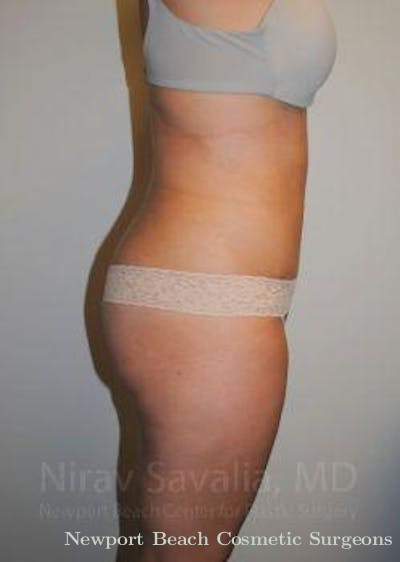 Breast Reduction Before & After Gallery - Patient 1655598 - After