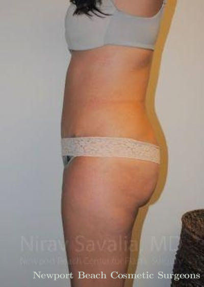 Fat Grafting to Face Before & After Gallery - Patient 1655598 - After