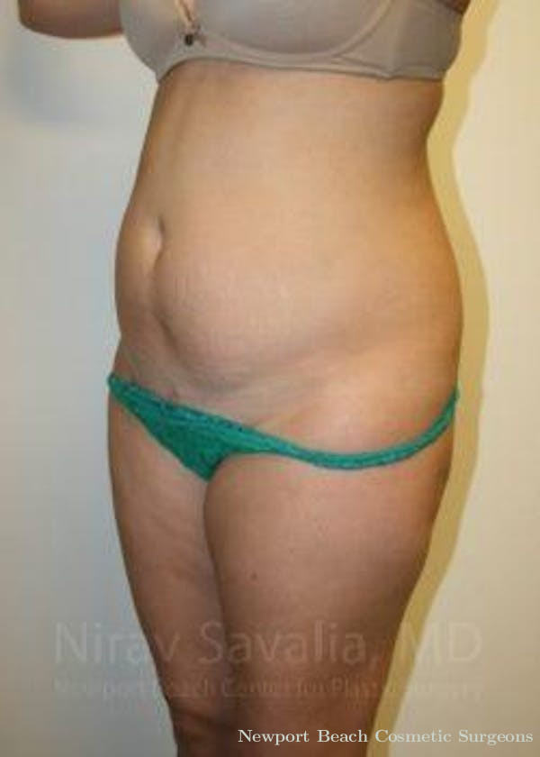 Abdominoplasty Tummy Tuck Before & After Gallery - Patient 1655598 - Before