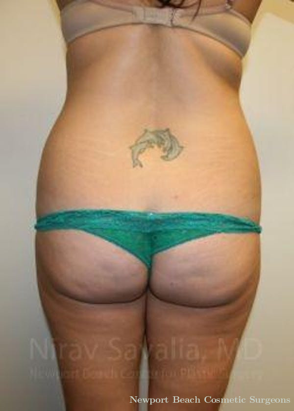 Body Contouring after Weight Loss Before & After Gallery - Patient 1655598 - Before