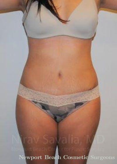 Breast Reduction Before & After Gallery - Patient 1655599 - After