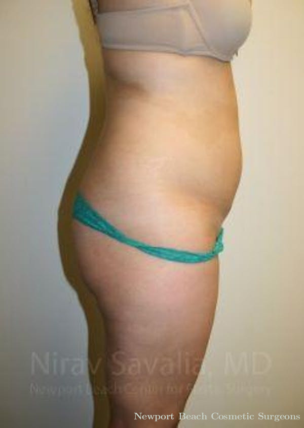 Mastectomy Reconstruction Revision Before & After Gallery - Patient 1655599 - Before