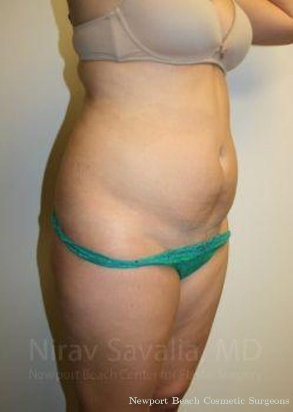 Mommy Makeover Before & After Gallery - Patient 1655599 - Before