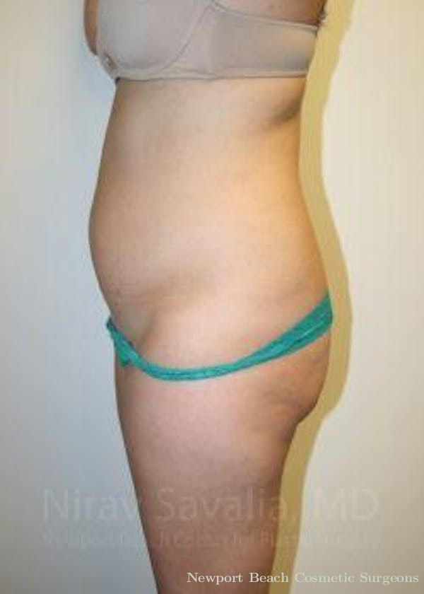 Thigh Lift Before & After Gallery - Patient 1655599 - Before