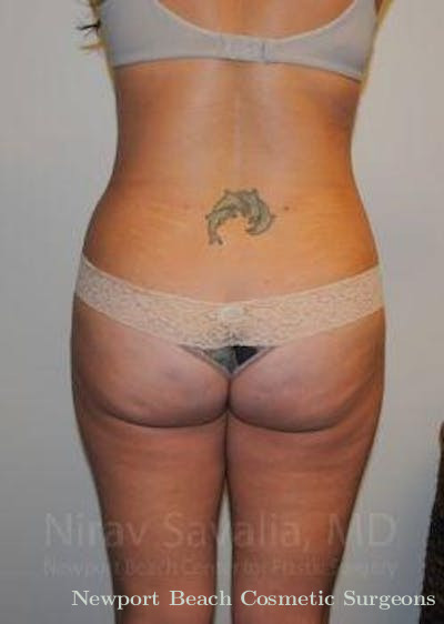 Liposuction Before & After Gallery - Patient 1655599 - After
