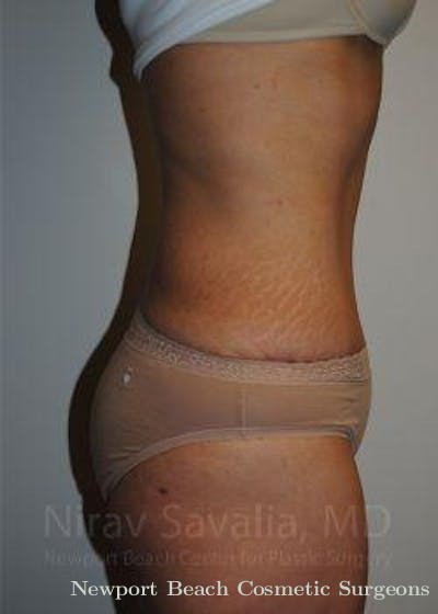 Thigh Lift Before & After Gallery - Patient 1655601 - After