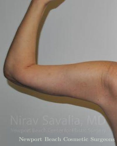 Arm Lift Before & After Gallery - Patient 1655600 - After