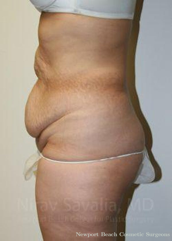 Breast Reduction Before & After Gallery - Patient 1655601 - Before