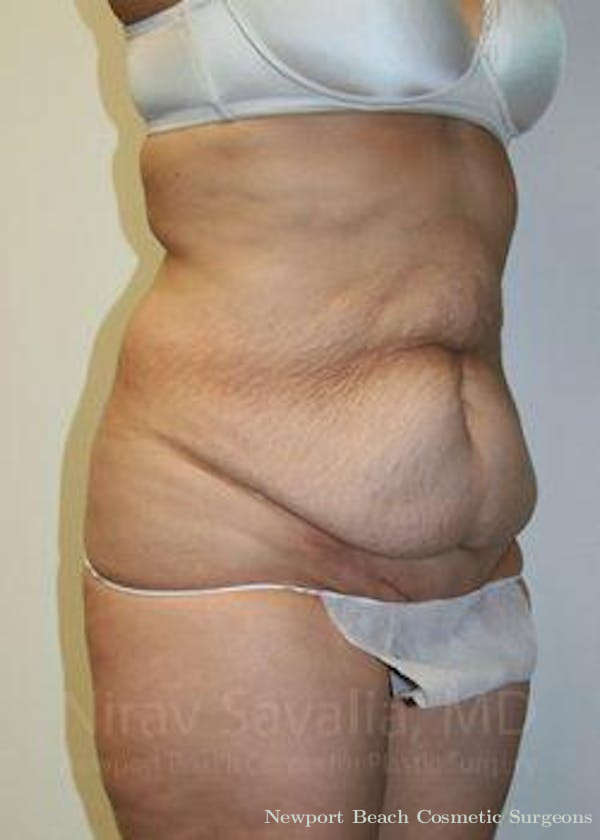 Body Contouring after Weight Loss Before & After Gallery - Patient 1655601 - Before