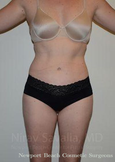 Breast Implant Revision Before & After Gallery - Patient 1655603 - After