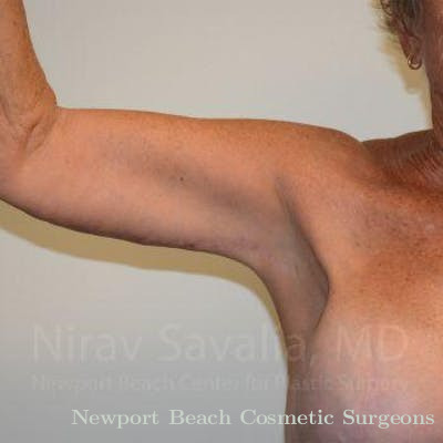 Breast Lift with Implants Before & After Gallery - Patient 1655602 - After