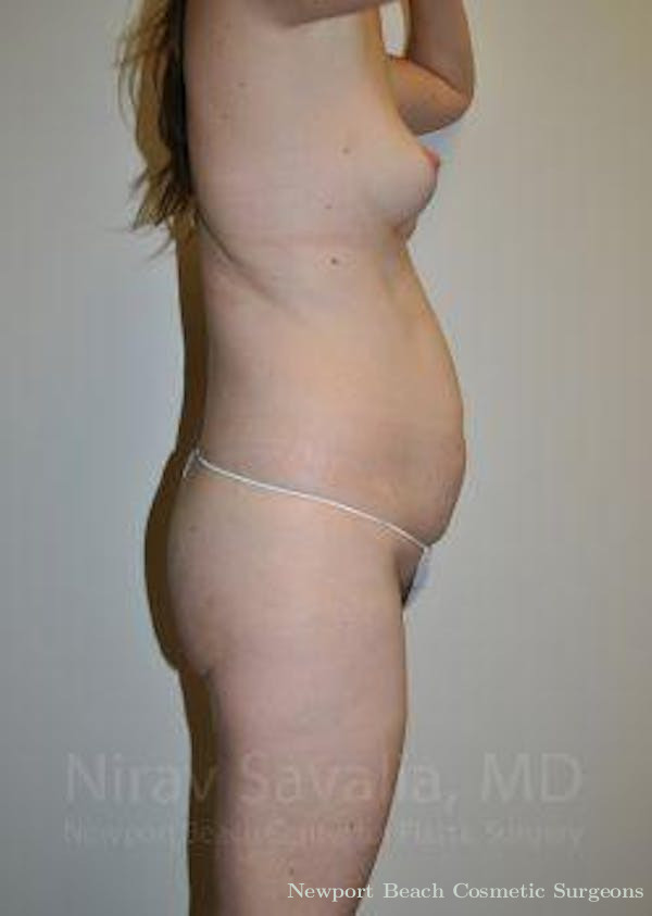 Breast Implant Revision Before & After Gallery - Patient 1655603 - Before