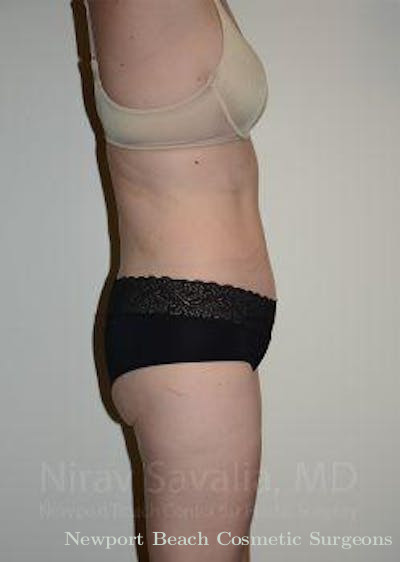 Mastectomy Reconstruction Revision Before & After Gallery - Patient 1655603 - After