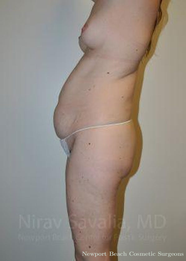 Thigh Lift Before & After Gallery - Patient 1655603 - Before