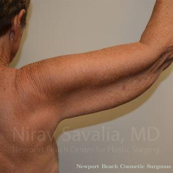 Arm Lift Before & After Gallery - Patient 1655602 - Before