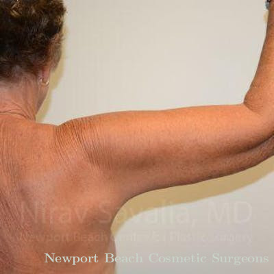 Mastectomy Reconstruction Revision Before & After Gallery - Patient 1655602 - After