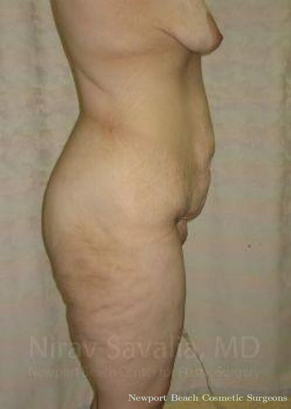 Thigh Lift Before & After Gallery - Patient 1655604 - Before