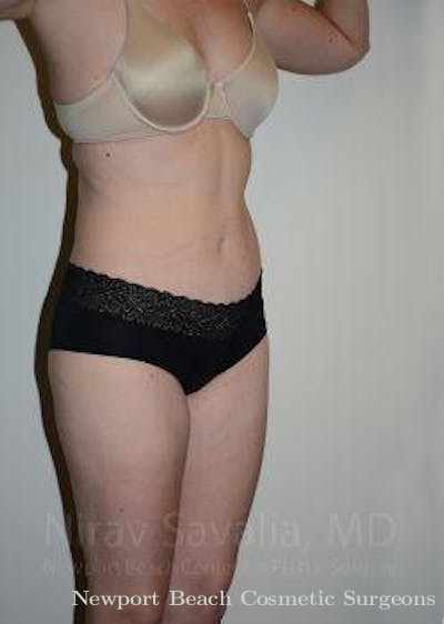 Mastectomy Reconstruction Revision Before & After Gallery - Patient 1655603 - After