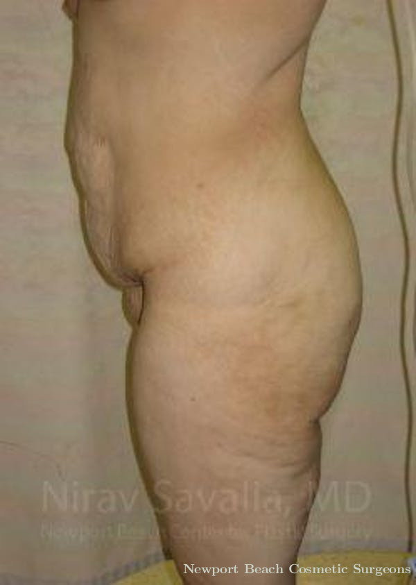 Abdominoplasty Tummy Tuck Before & After Gallery - Patient 1655604 - Before