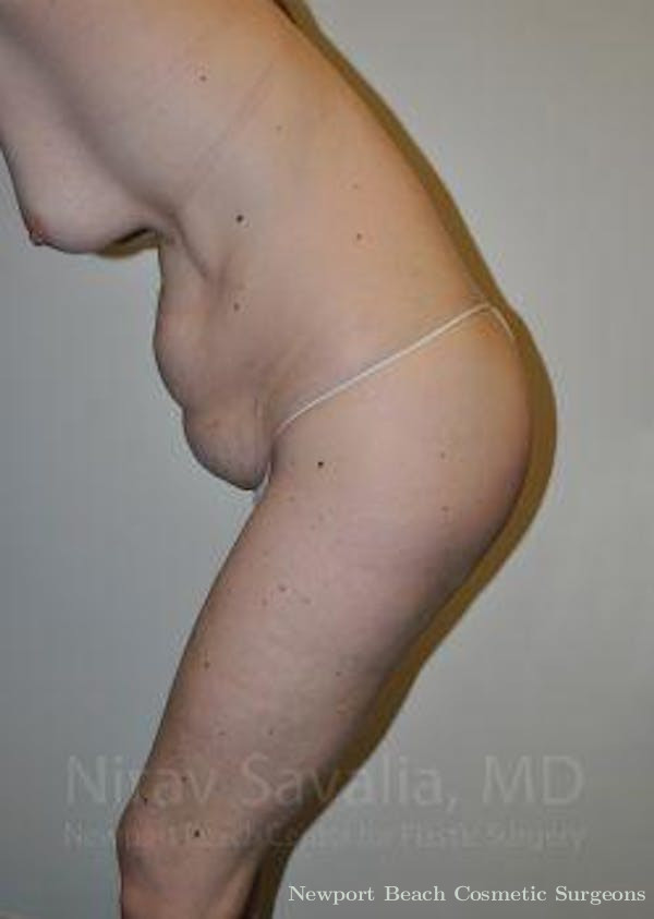 Abdominoplasty Tummy Tuck Before & After Gallery - Patient 1655605 - Before