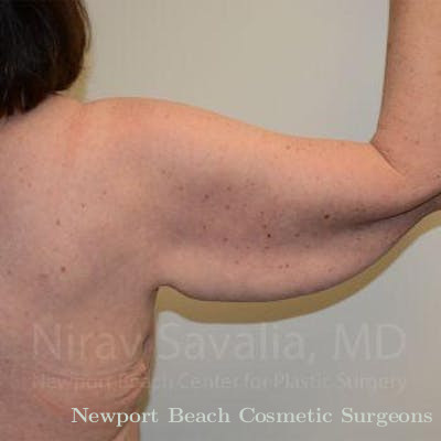 Breast Explantation En Bloc Capsulectomy Before & After Gallery - Patient 1655606 - Before