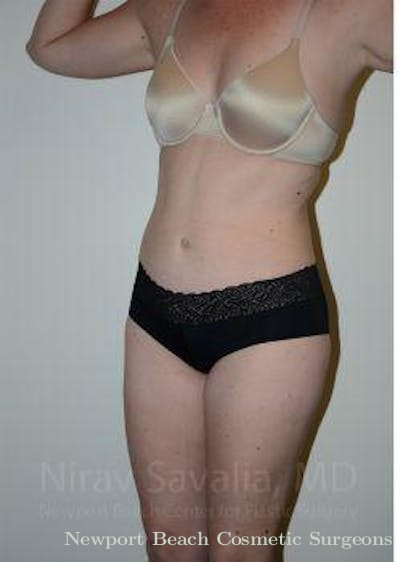 Breast Lift with Implants Before & After Gallery - Patient 1655605 - After