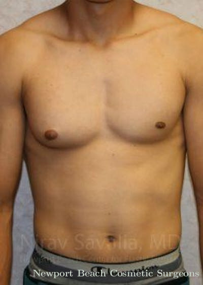 Breast Implant Revision Before & After Gallery - Patient 1655607 - Before