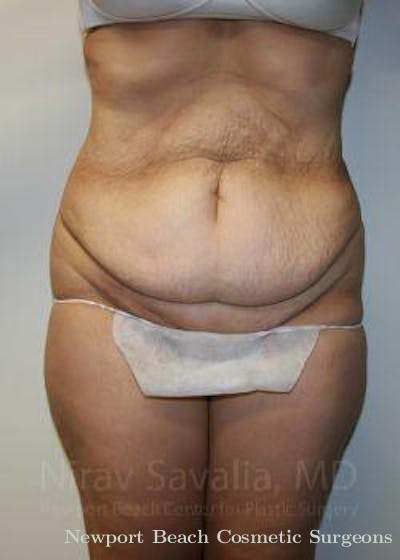 Mastectomy Reconstruction Revision Before & After Gallery - Patient 1655608 - Before