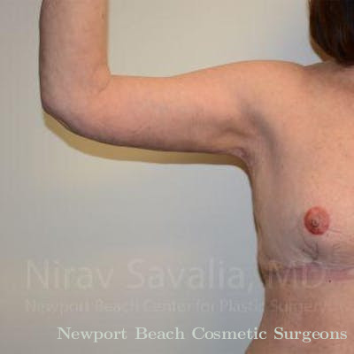 Oncoplastic Reconstruction Before & After Gallery - Patient 1655606 - After