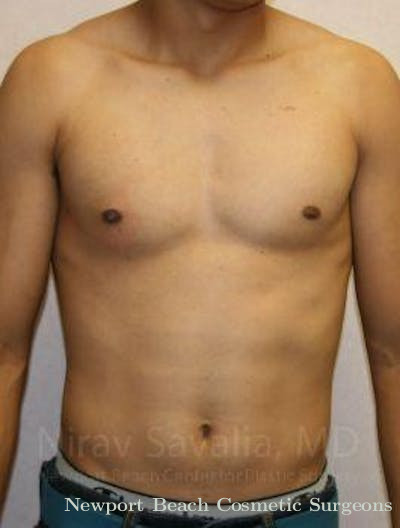 Breast Augmentation Before & After Gallery - Patient 1655607 - After