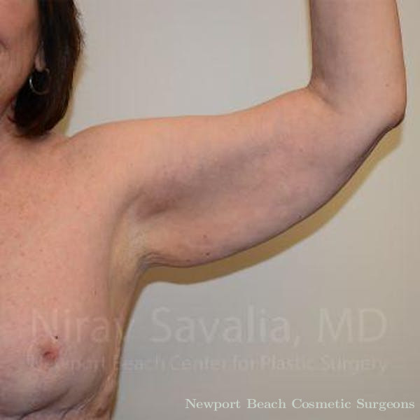 Oncoplastic Reconstruction Before & After Gallery - Patient 1655606 - Before
